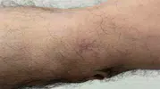 Dirseğindeki küçük yarayı önemsemedi, kanser olduğunu öğrendi