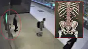 Yürümekte zorlanınca yakayı ele verdi! Midesinden bakın neler çıktı!