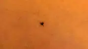 İnegöl'de oyun oynayan çocuğun göğsüne kene yapıştı