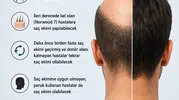 Kel olanlara müjde Saç klonlama dönemi başlıyor