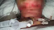 Güzellik uğruna ölümün kıyısından döndü: Basit bir işlem kabusa dönüştü