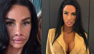 Katie Price geçirdiği operasyon sonrası son halini paylaştı