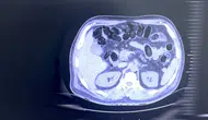 Batman yolunda midesine sakladığı uyuşturucuyla yakalandı