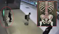 Yürümekte zorlanınca yakayı ele verdi! Midesinden bakın neler çıktı!