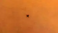 İnegöl'de oyun oynayan çocuğun göğsüne kene yapıştı