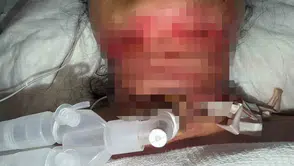 Güzellik uğruna ölümün kıyısından döndü: Basit bir işlem kabusa dönüştü