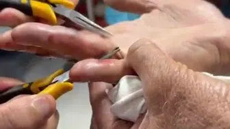 Parmağına sıkışan yüzük kabusu hastanede bitti