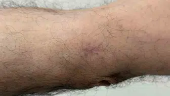 Dirseğindeki küçük yarayı önemsemedi, kanser olduğunu öğrendi
