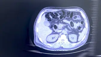 Batman yolunda midesine sakladığı uyuşturucuyla yakalandı