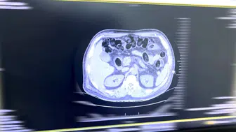 Batman yolunda midesinde uyuşturucu taşıyan şüpheli tutuklandı