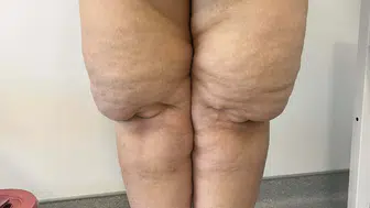 Bacaklarınızdaki ağrı ve morluklar sadece kilo sorunu olmayabilir