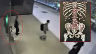 Yürümekte zorlanınca yakayı ele verdi! Midesinden bakın neler çıktı!
