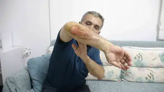 Isparta'da köpek saldırısı Engelli gencin dünyası karardı