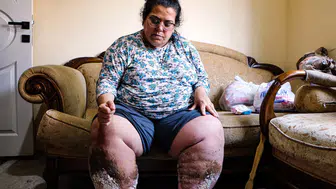 Adana'da yaşam mücadelesi veren anne tedavi olmak istiyor