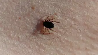 Doğu Karadeniz'de kene vakaları düşüşte
