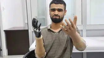 Elektrik kazasında uzuvlarını kaybeden Muhammed’e hayırseverlerden büyük destek