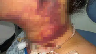 Güzelleşmek isterken ölümden döndü: Estetik operasyon sonrası kabus dolu günler