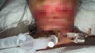 Güzellik uğruna ölümün kıyısından döndü: Basit bir işlem kabusa dönüştü