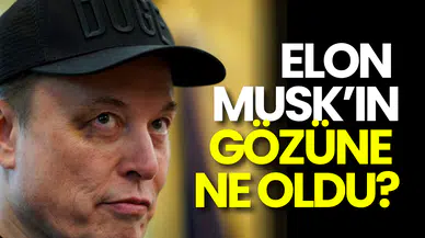 Trump, Elon Musk’a Veda Etti: Musk’ın Morarmış Gözü Olay Oldu!