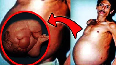 “Hamile adam” gerçeği: Karnından 36 yıllık ikizi çıktı