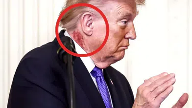 Trump’ın boynundaki kızarıklığın nedeni belli oldu