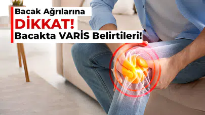 Bacak Ağrılarına Dikkat! Bacakta Varis Belirtileri Neler?
