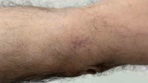 Dirseğindeki küçük yarayı önemsemedi, kanser olduğunu öğrendi
