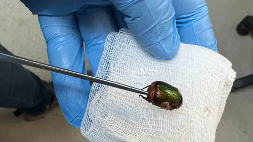 Manisalı çiftçinin kulağından Japon böceği çıktı