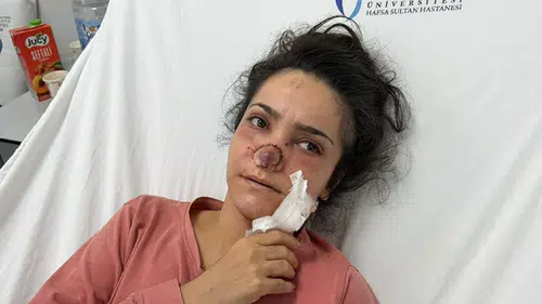 Manisa’da dehşet anları Eşi tarafından burnu koparıldı