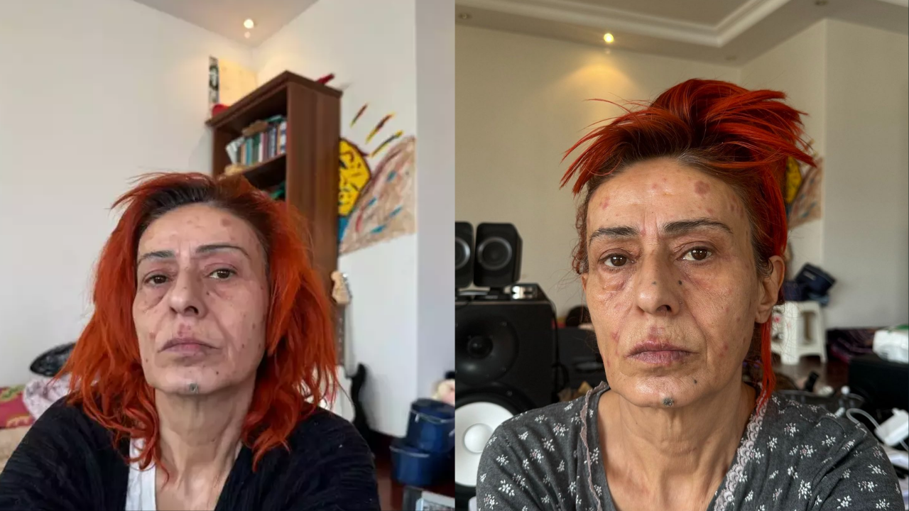 Yıldız Tilbe’nin Saç Boyası Kabusu Yüzünde Kimyasal Yanıklar Oluştu