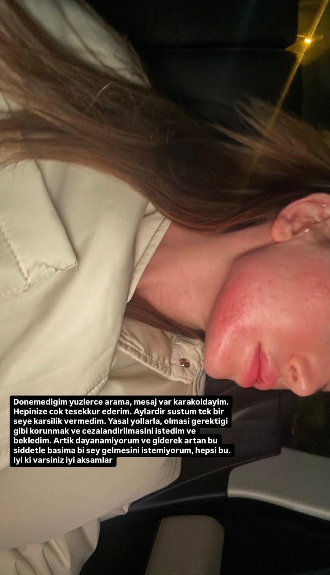 Danla Bilic Eski Sevgilisi Berk Çetin Tarafından Darp Edildi “Aylarca Sustum, Artık Dayanamıyorum” (4)