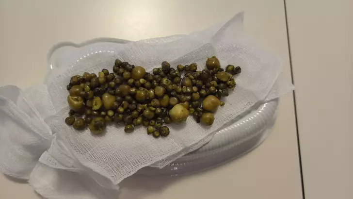 Bursa’da 77 Yaşındaki Kadının Safra Kesesinden 213 Taş Çıkarıldı3