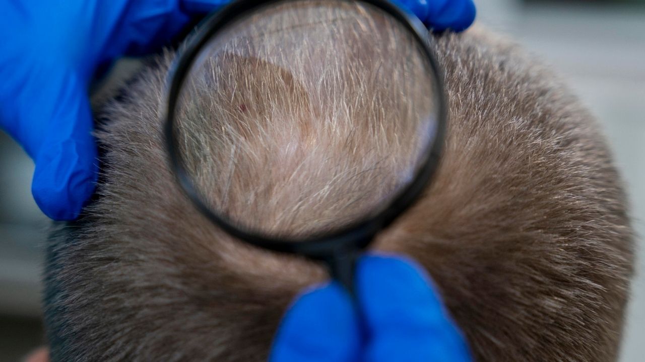 Clascoterone Kellik Tedavisi Uzman Yorumu (4)