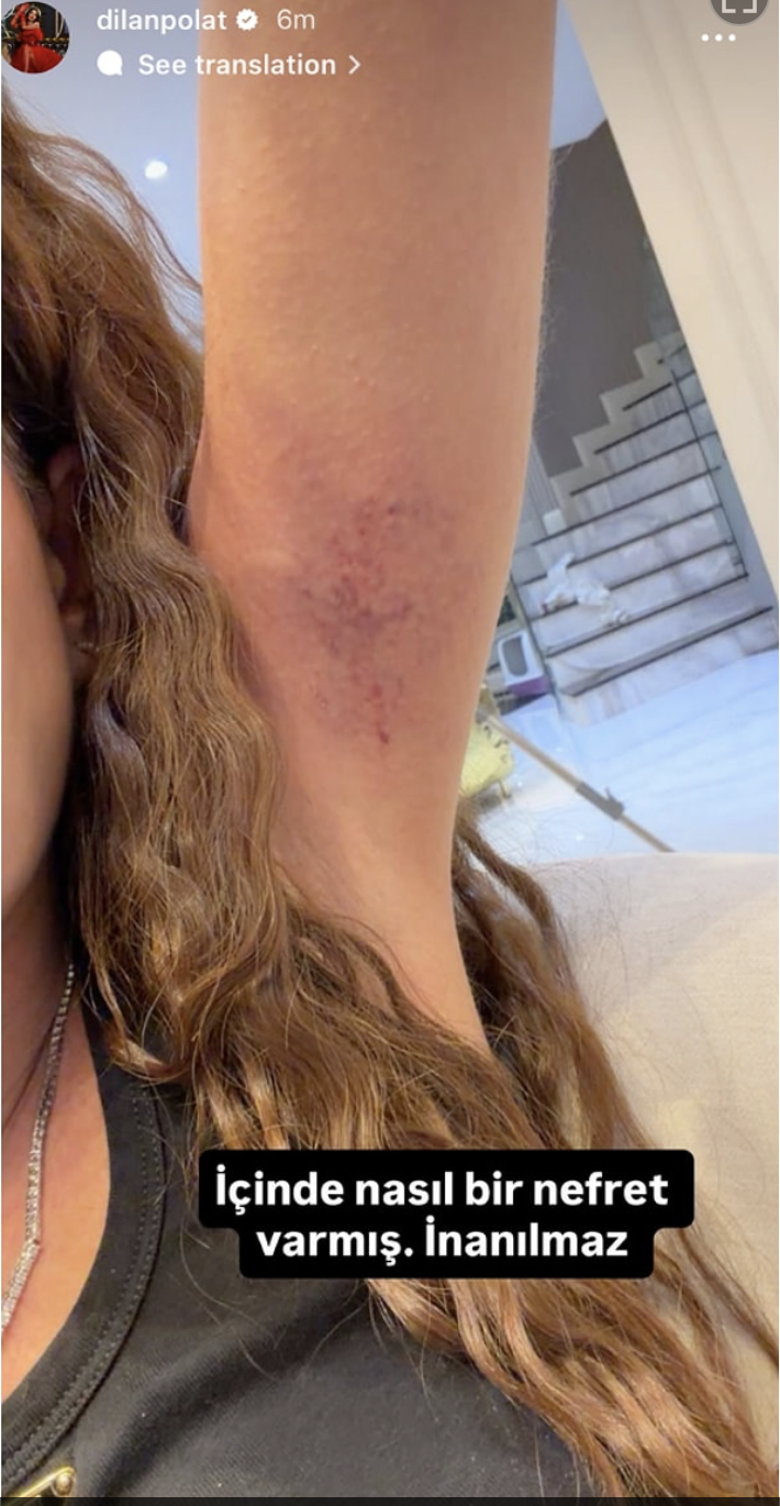 Dilan Polat Dayak 2-1