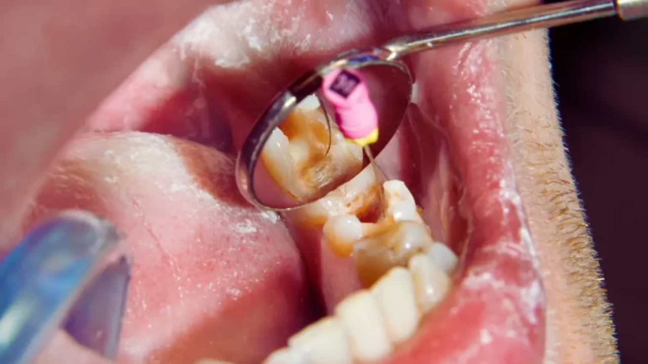 Kanal Tedavisi Nedir, Kimlere Yapılır (3)