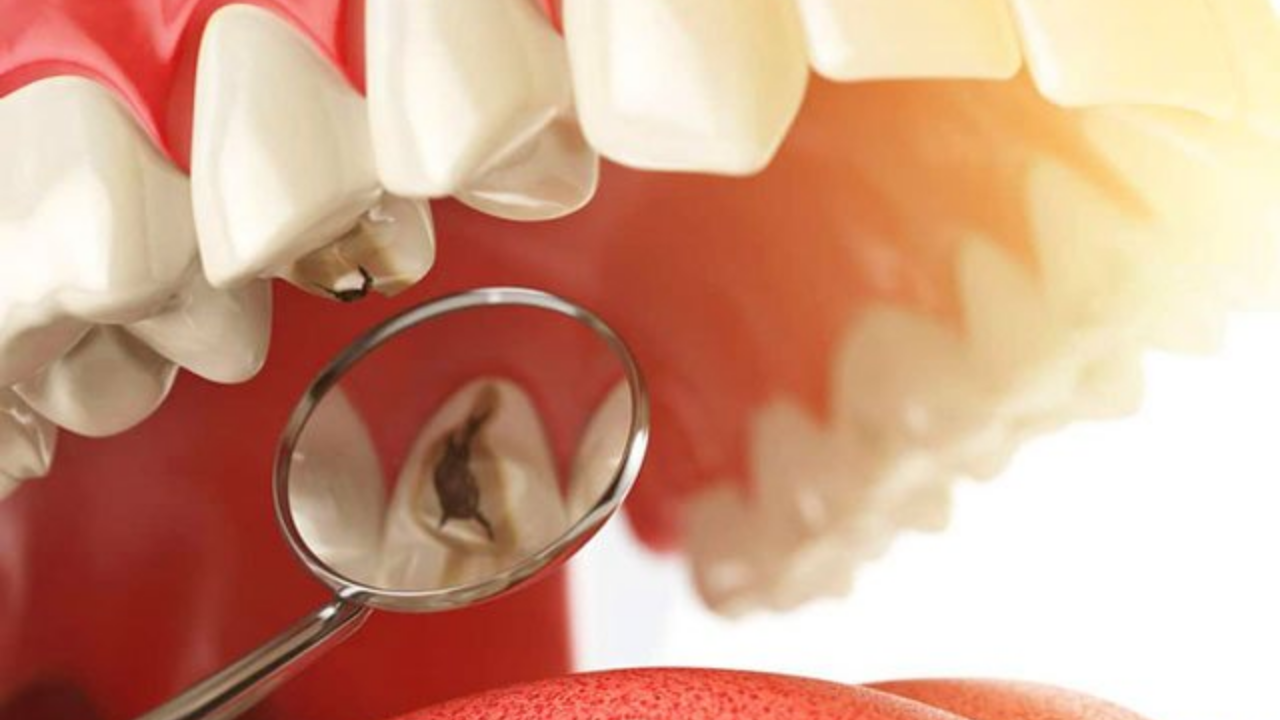 Kanal Tedavisi Nedir, Kimlere Yapılır (4)