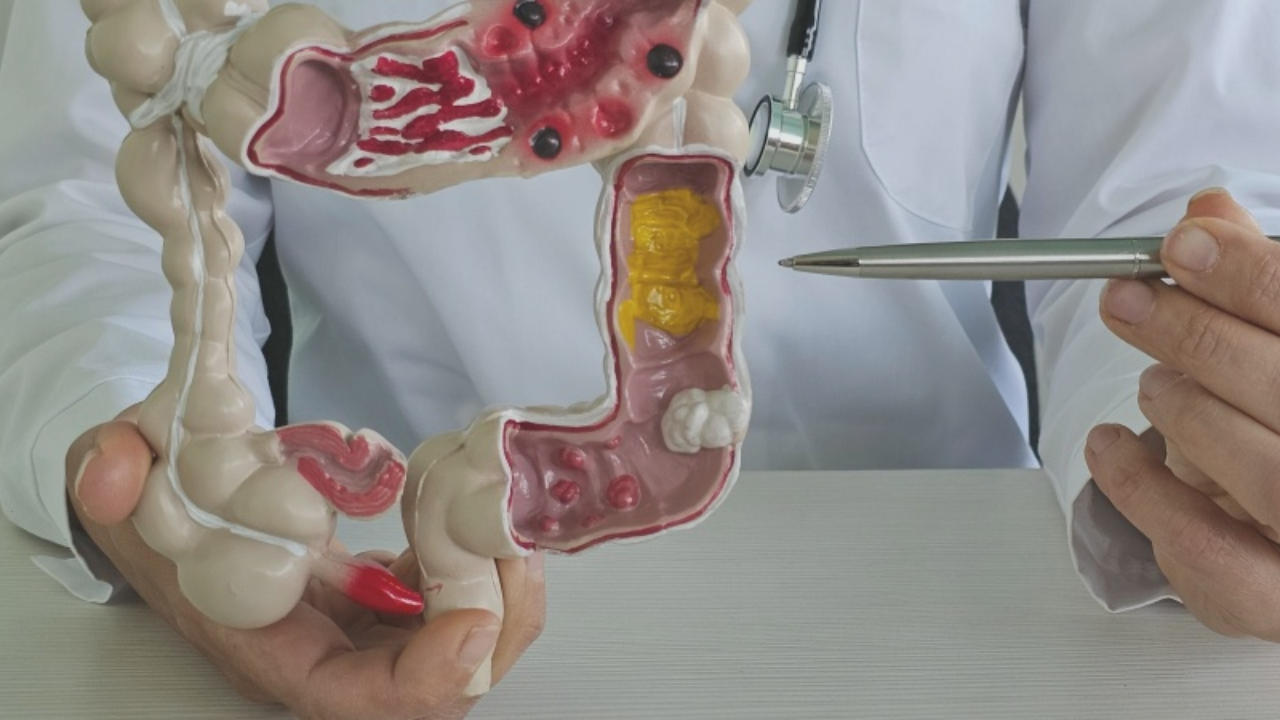 Murat Cemcir'in Hastalığı Divertikül Kanaması Nedir (1)