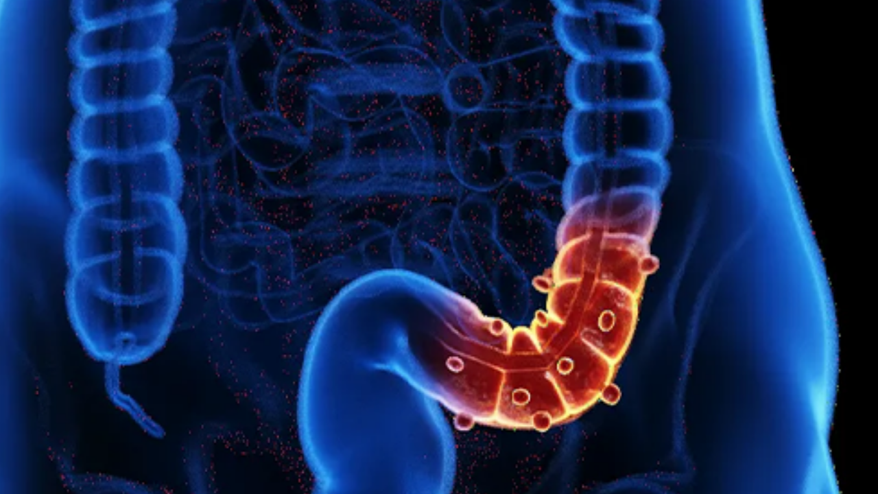 Murat Cemcir'in Hastalığı Divertikül Kanaması Nedir (3)