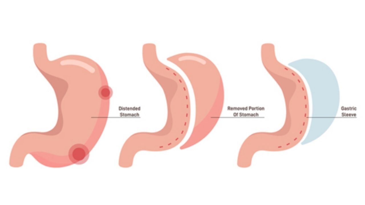 Tüp Mide Ameliyatının Zorlukları