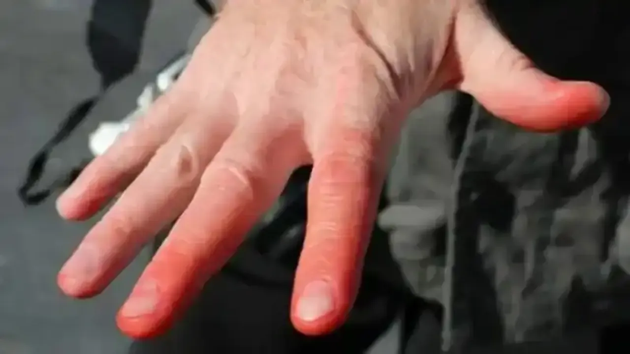 Kışın Sessiz Tehlikesi Soğuk Isırığı Parmak Kaybına Yol Açabiliyor