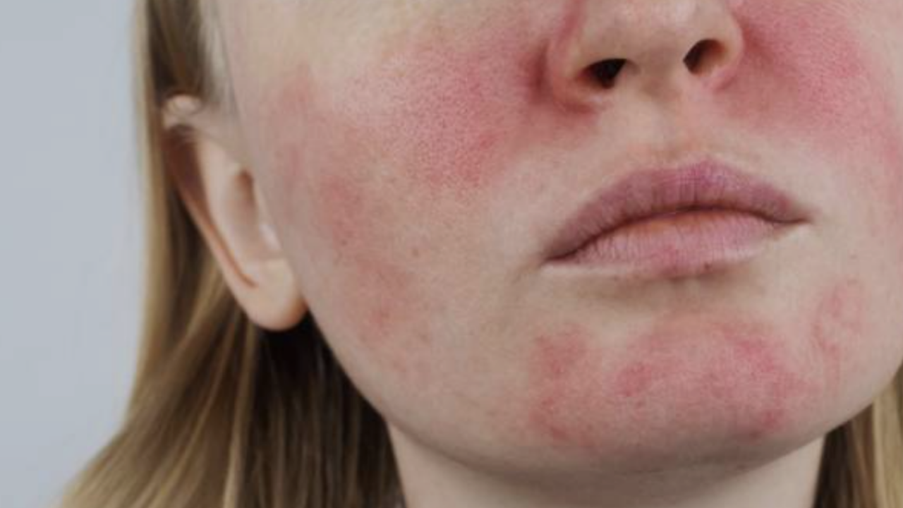 Roza Hastalığı (1)