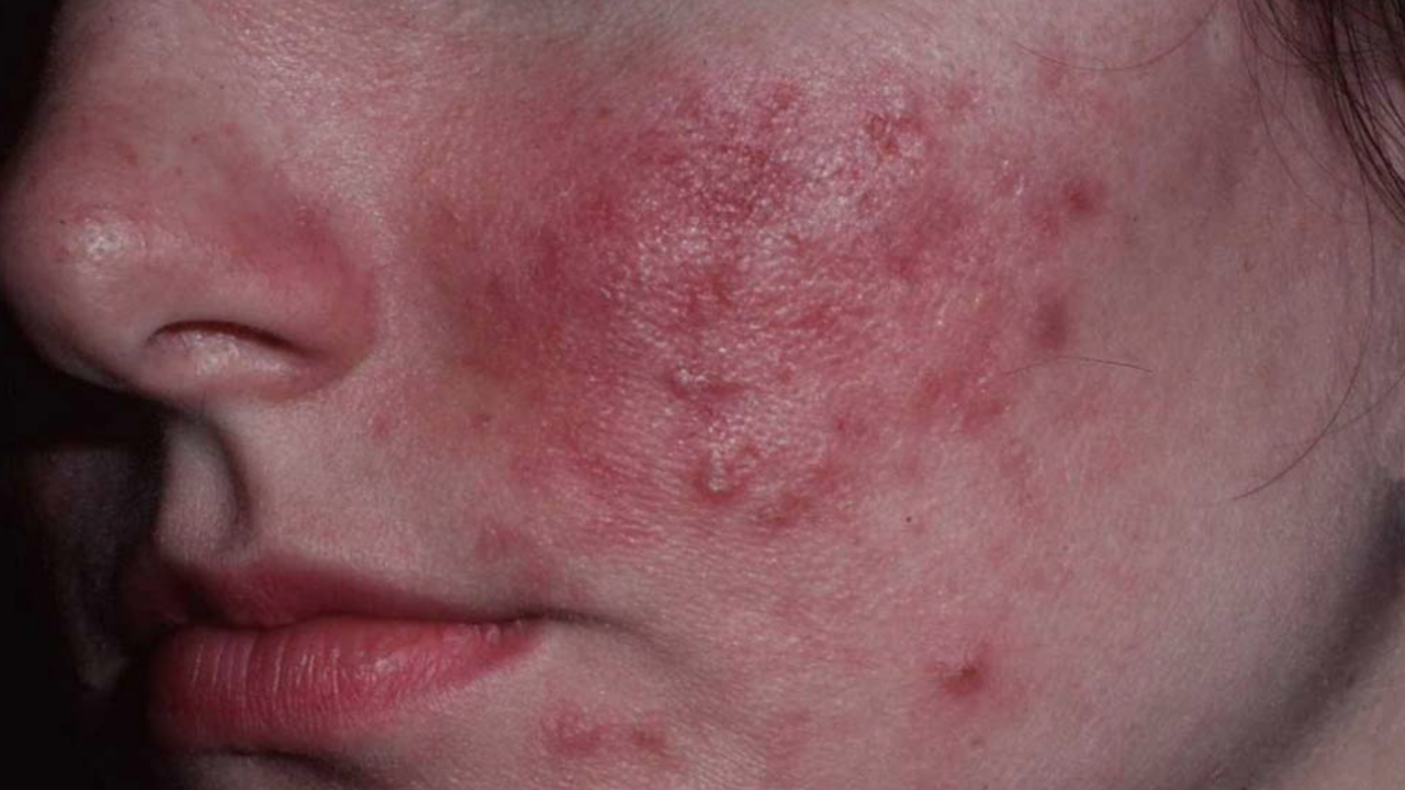 Roza Hastalığı (3)