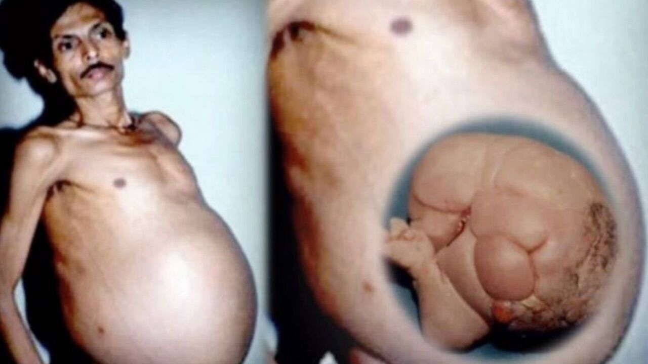 Ikizini Karnında Taşıyan Adam 2