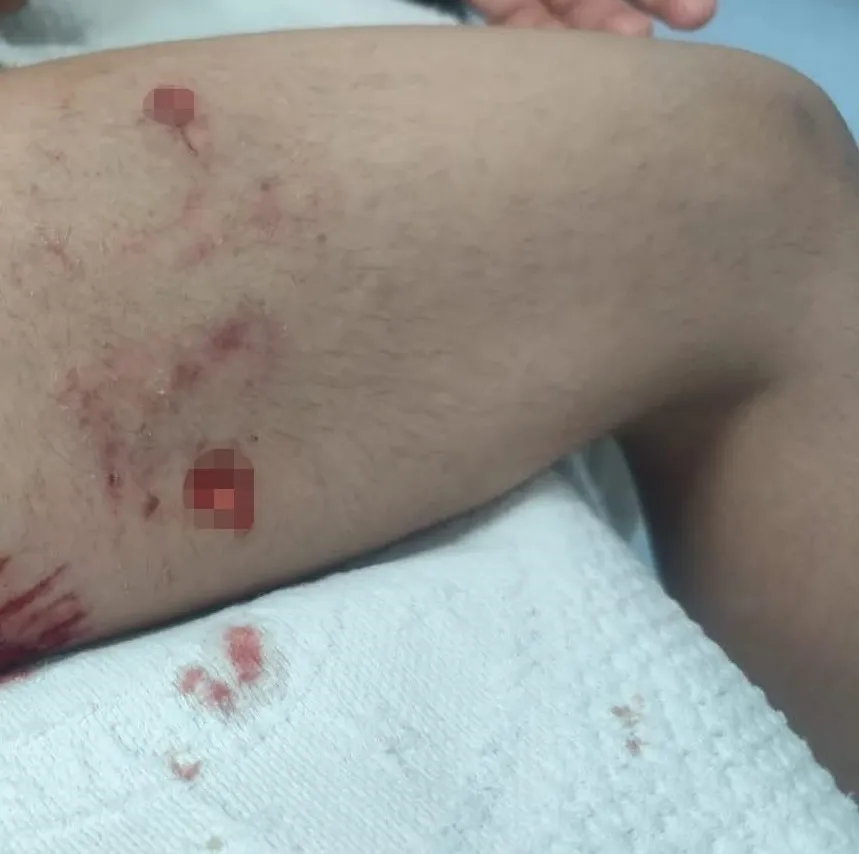 Viranşehir'de okul yolunda dehşet anları: 8 yaşındaki öğrenci köpeklerin hedefi oldu