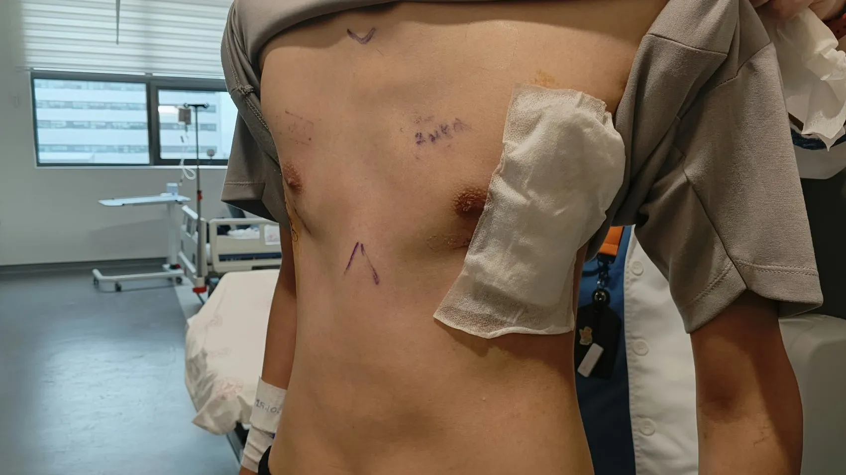 Kunduracı göğsü kabusuna Samsun'da teknolojik çözüm: 17 yaşındaki gencin hayatı değişti