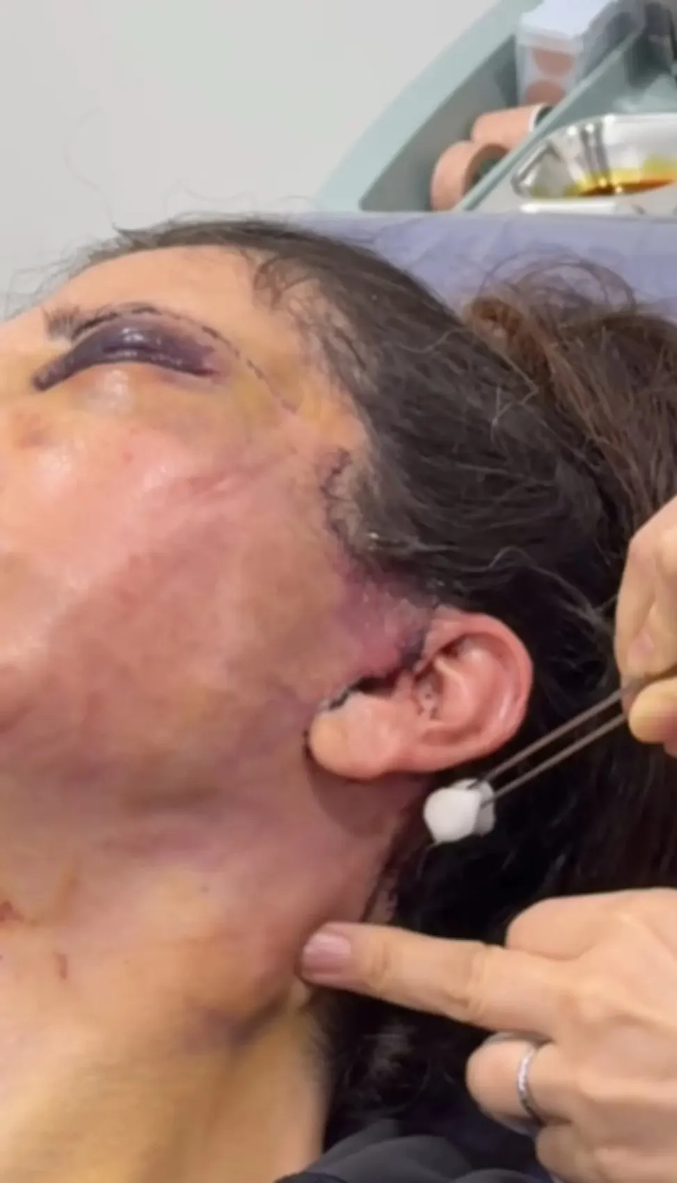 Yüz naklinin ardından revizyon ameliyatı olmuştu! Didem Ceran son haliyle yine gündemde 2