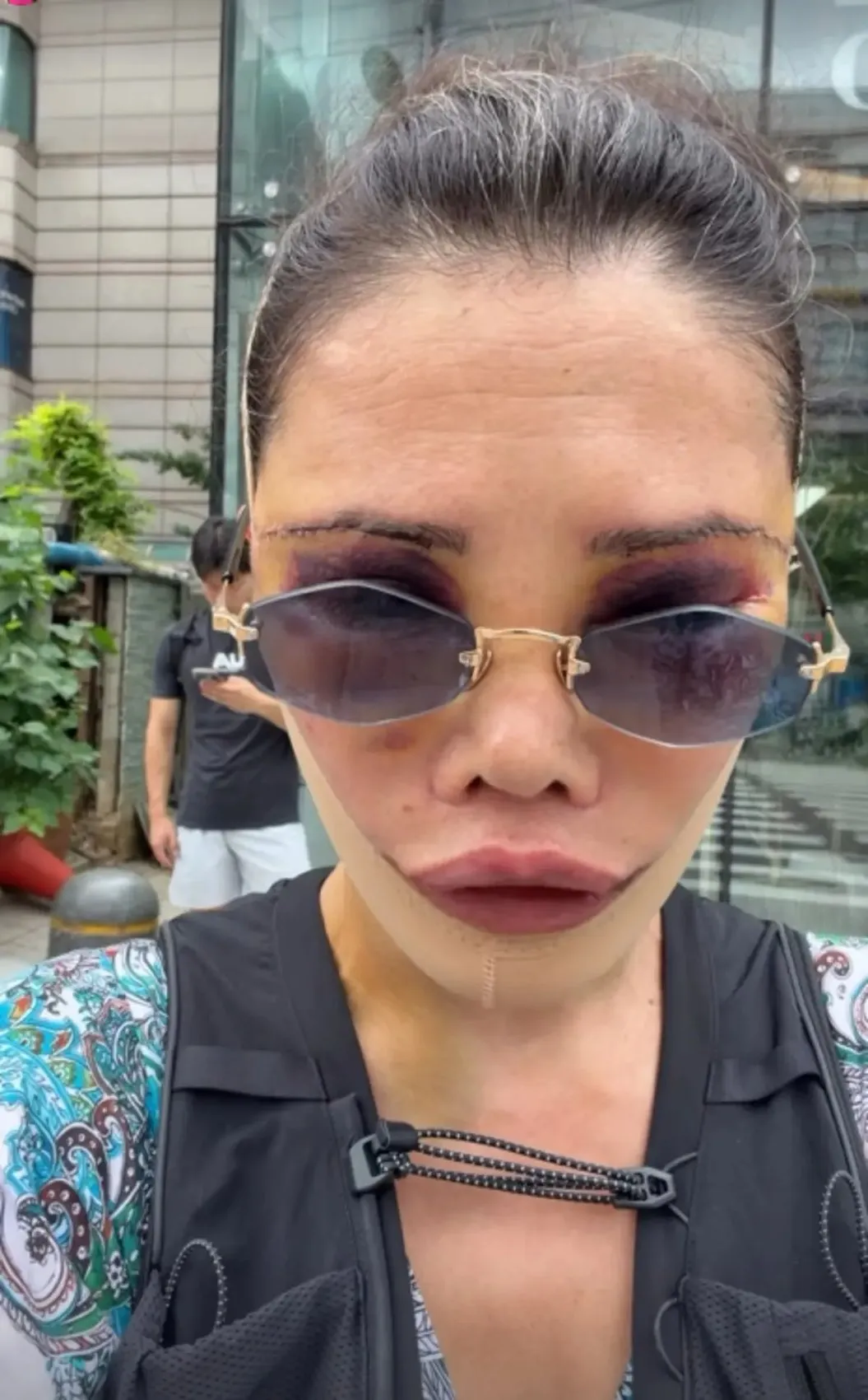 Yüz naklinin ardından revizyon ameliyatı olmuştu! Didem Ceran son haliyle yine gündemde 3