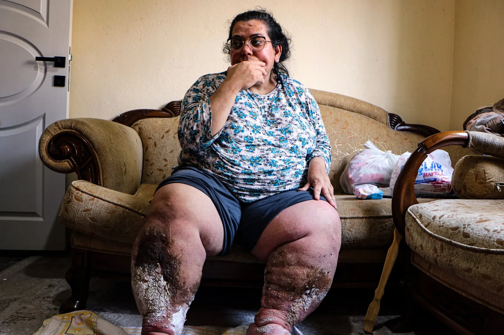 Adana'da yaşam mücadelesi veren anne tedavi olmak istiyor