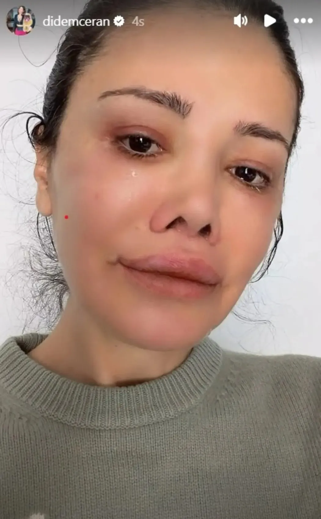Kore de yüz nakli yaptırmıştı! Didem Ceran bir kez daha bıçak altına yattı! Son haline kimse dayanamadı 2