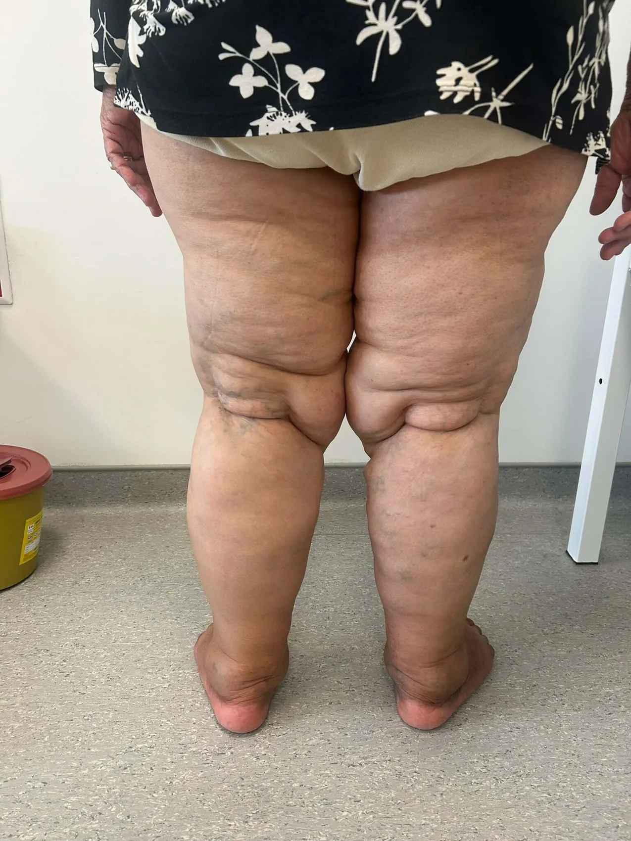 Bacaklarınızdaki ağrı ve morluklar sadece kilo sorunu olmayabilir